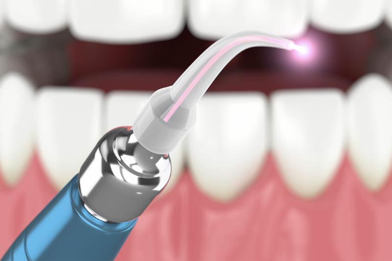 Soft Tissue Laser Treatment in Spring